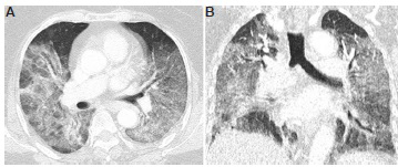 CT chest of a 70 yr old woman, RT-PCR positive for COVID-19, who presented with unexplained clinical deterioration. (A and B) Lung window (axial and coronal sections) showing bilateral, diffuse areas of ground-glass opacities and patchy consolidation, which demonstrate anteroposterior gradient and predominance in dependent regions of the lungs. CT and clinical features were consistent with acute respiratory distress syndrome. The patient expired the next day.