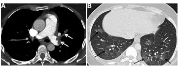 A 40 yr old male patient with COVID-19 pneumonia developed sudden onset of breathlessness. CT pulmonary angiography was done. (A) Axial section in the mediastinal window showing hypodense filling defects in the left pulmonary artery and its upper lobar branch, suggestive of pulmonary embolism (white arrows). (B) Axial section in the lung window showing patchy ground-glass opacities in the lower lobes (black arrows), findings consistent with COVID-19 pneumonia.