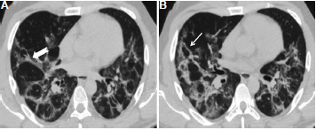 CT chest of a 55 yr old male patient who had COVID-19 pneumonia a few months back. Symptoms had resolved since then except dyspnoea and hypoxia, which worsened over last few days. RT-PCR test for COVID-19 done on the same day as computed tomography was negative. (A and B) Axial CT sections in lung window showed lung architectural distortion with atelectasis, parenchymal bands (thick arrow), coarse reticulation and irregular interlobular septal thickening (thin white arrow) which was predominant in the lower lobes. The patient gave no history of any occupational exposure or other fibrosing lung disease.