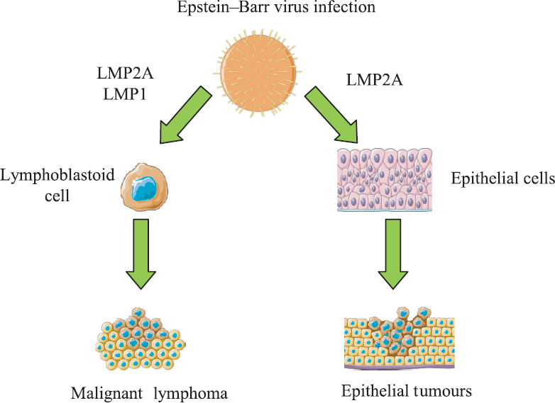 Pathogenetic mechanisms of Epstein–Barr virus on carcinogenesis. EBV is associated with different human tumours. EBV may infect B lymphocytes, leading to a malignant transformation into a lymphoma. Also, EBV may transform epithelial cells into epithelial tumours, LMP: EBV latent membrane protein; EBV, Epstein–Barr virus. Source: Ref 56.