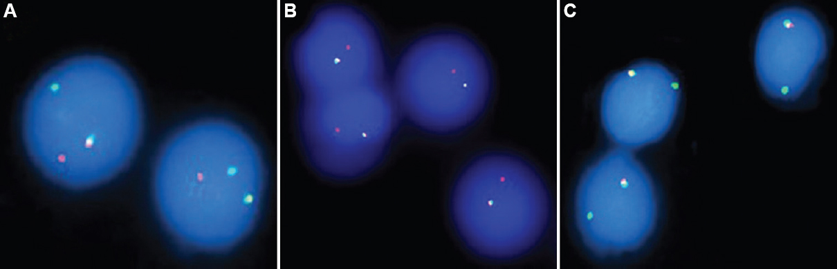 (A) Dual-colour IgH break apart probe on interphase cells shows normal IgH allele (one yellow signal) and residual IgH (one red and one green signal); (B) Dual-colour IgH break apart probe on interphase cells shows normal IgH allele (one yellow signal), Residual 3’ IgH (one red signal); (C) Dual-colour IgH break apart probe on interphase cells shows normal IgH allele (one yellow signal), deletion in 3’ IgH region (one green signal).