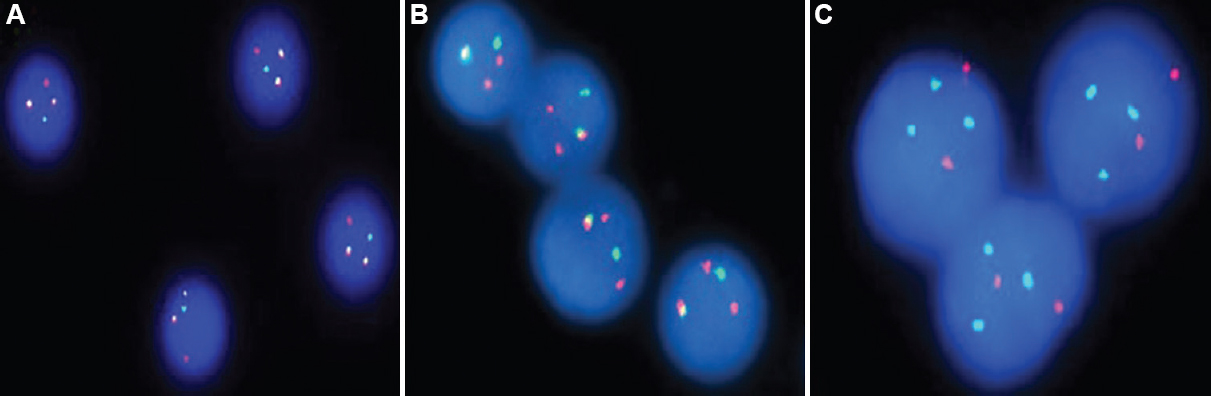 (A) IgH/CCND1 dual-fusion probe shows IgH-CCND1 fusion (two yellow signals), 1 normal IgH allele and 1 normal CCND1 allele (one green and one red signal, respectively); (B) IgH/BCL3 dual-fusion probe shows IgH-BCL3 fusion (one yellow signal), one IgH allele and two normal BCL3 allele (one green and two red signals); (C) IGH/MYC dual-fusion probe shows t(14;?)(q32;?) with an unidentified partner, 3’IgH allele and 2 normal MYC allele (3 green and 2 red signals).