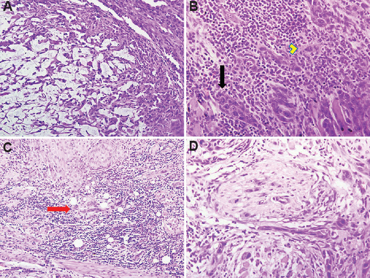 (A) Invasive tumour front with discohesive and spindled out tumour cells, indicating EMT (H and E, ×100). (B) Invasive front showing tumour islands of <15 cells (arrow) and tumour buds (arrow head) with dense inflammation (upper left) composed predominantly of lymphocytes (H and E, ×100). (C) Invasive tumour front with tumour buds formed of 4-8 cell groups (arrow) separated by dense lymphocytic infiltrate type -1. Splayed muscle bundles seen at the bottom of picture (H and E, ×100). (D) Nerve bundle infiltrated and surrounded by tumour cells (H and E, ×200).