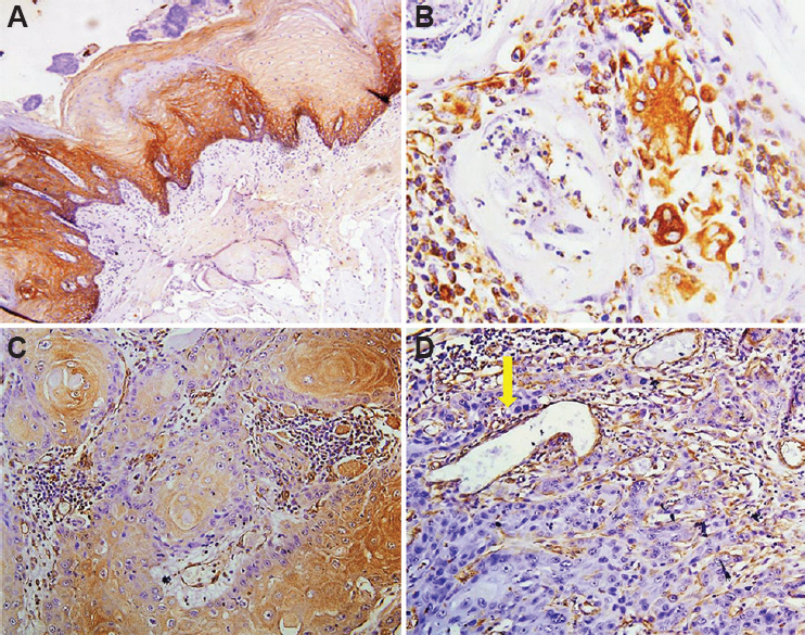 (A) Positive control for E-cadherin: expression in the adjacent normal mucosal epithelium (×100). (B) Vimentin positivity in the stromal cells, few lymphocytes and histiocytic collections acting as an internal control (×200). (C) E-cadherin expression seen at the centre of tumour islands in the most differentiated cells with loss in the peripheral cells and tumour buds (×100). (D) Vimentin positivity seen only in the stromal cells and vessels (arrow) and not in the tumour cells. This positivity acted as an internal control (×100).
