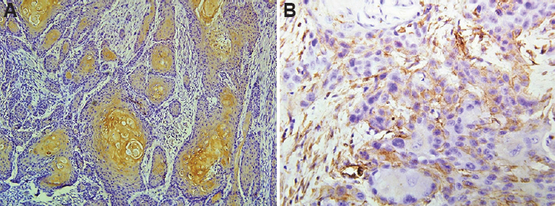 (A) Brown granular membranous E-cadherin positivity in centre of tumour islands (×200). (B) Vimentin positivity in cytoplasm of tumour cells at the infiltrating edge of the tumour (×200).