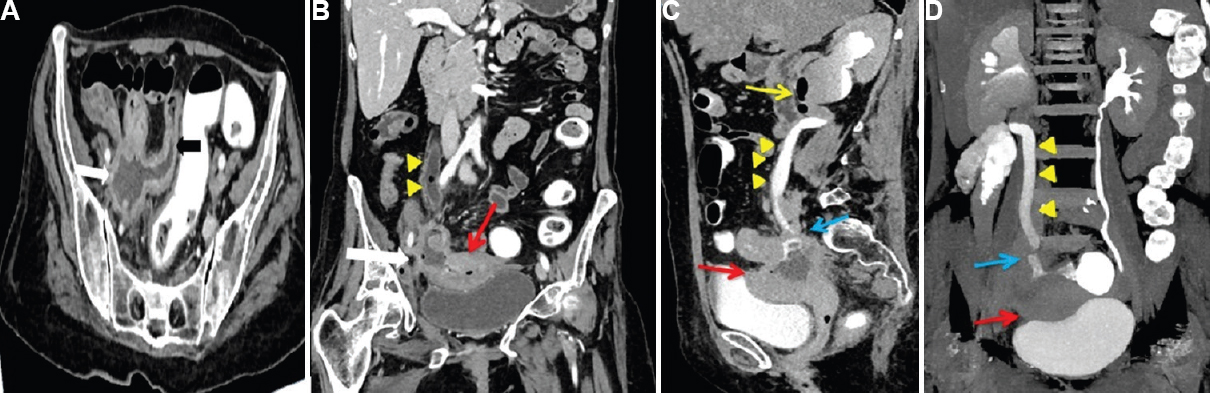 (A) Computed Tomography image with rectal contrast showing a collection in right adnexal region (white arrow) communicating with terminal ileum (black arrow); (B) Coronal reformat shows dilated right ureter (yellow arrowheads) with air foci in it. Ileal fistula (white arrow) with uterus (red arrow) is also noted along with air foci in endometrial cavity; (C and D) Delayed imaging showed dilated, contrast filled right ureter (yellow arrowheads) with hydronephrosis and air foci in renal pelvis and upper ureter (yellow arrow). Ileo-ureteric fistula (blue arrow) is seen posterior to uterus (red arrow).