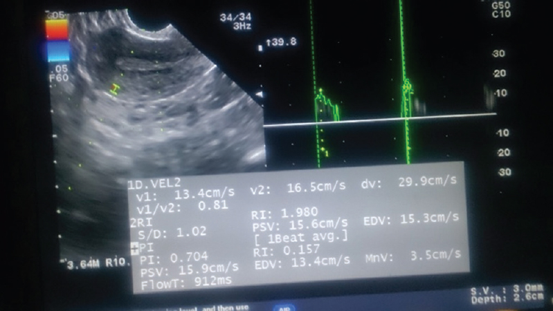 Representative scan showing Doppler indices of endometrium measured in the secretory phase.