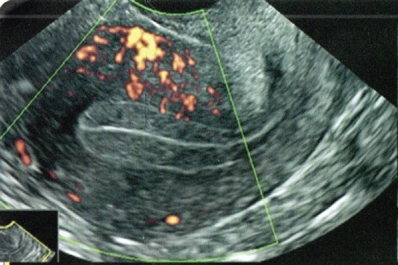 Representative 2DTVS scan showing vascular zone of endometrium in zone 1.