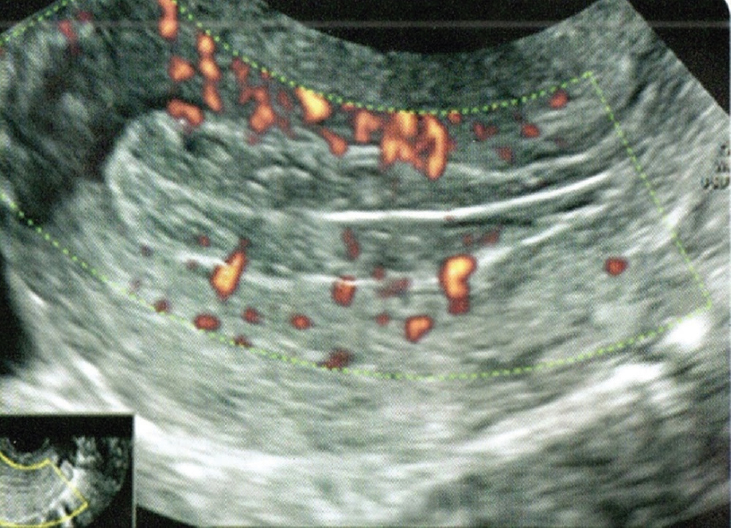 Representative 2DTVS scan showing vascular zone of endometrium in zone 2.