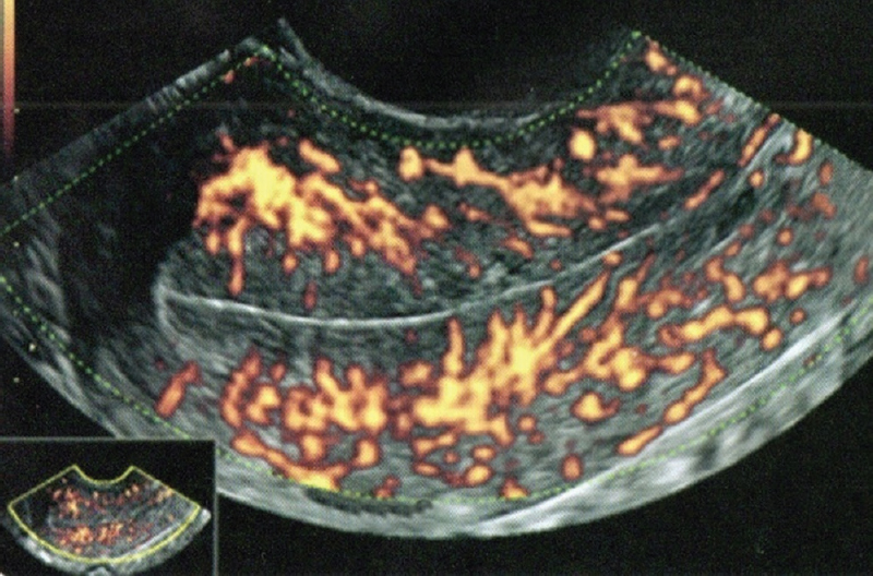 Representative 2DTVS scan of the vascular zone of endometrium in zone 3.