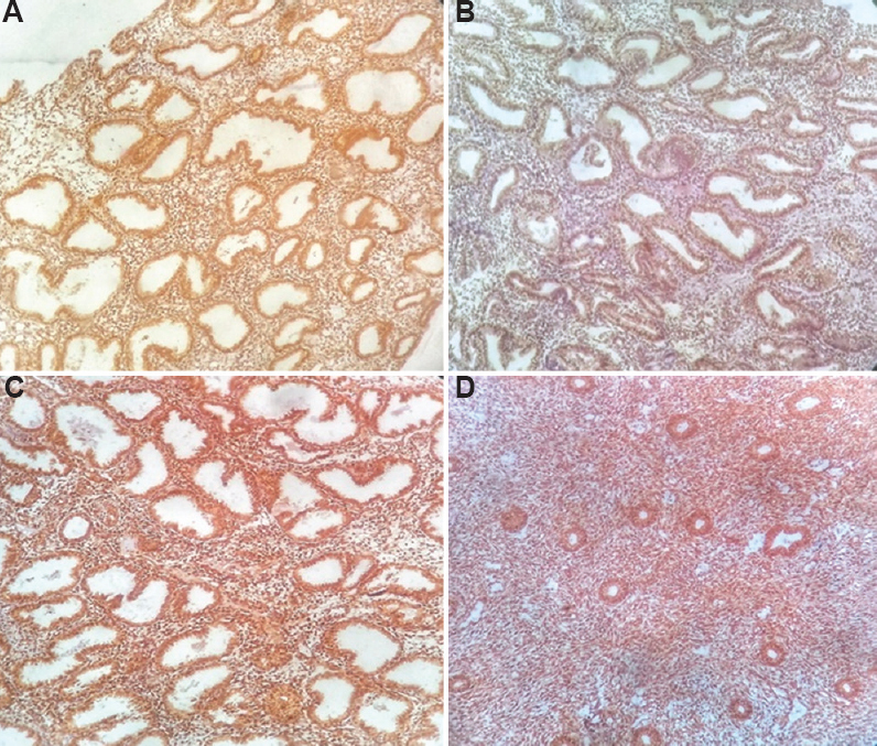 Endometrial gland vascular endothelial growth factor after immune histochemical staining. (A) grade I, (B) grade 2, (C) grade 3 & (D) grade 4.