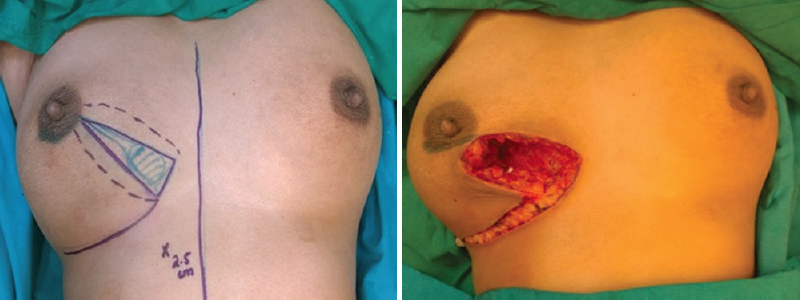 J-plasty for lower inner quadrant tumour.