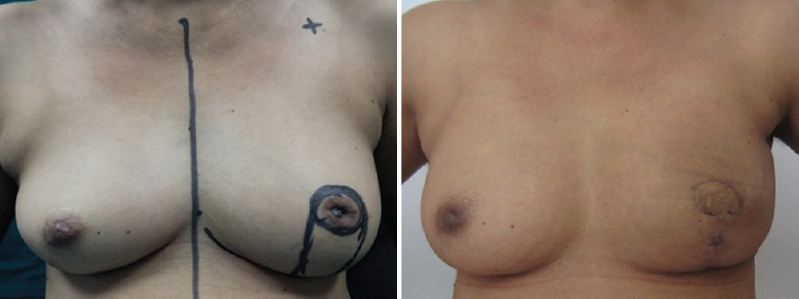 Grissoti flap for retroareolar tumour.