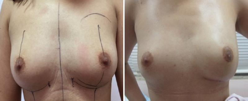 Skin saving nipple preserving mastectomy with sentinel node biopsy with silicone implant reconstruction for a multicentric EBC with extensive microcalcification.