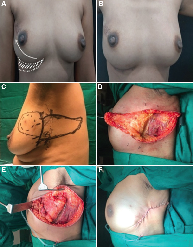(A and B) LICAP (anterior branch based) flap from inframammary fold for right breast UOQ volume replacement; and (C-F) LICAP (posterior branch based) flap for left breast UOQ volume replacement.