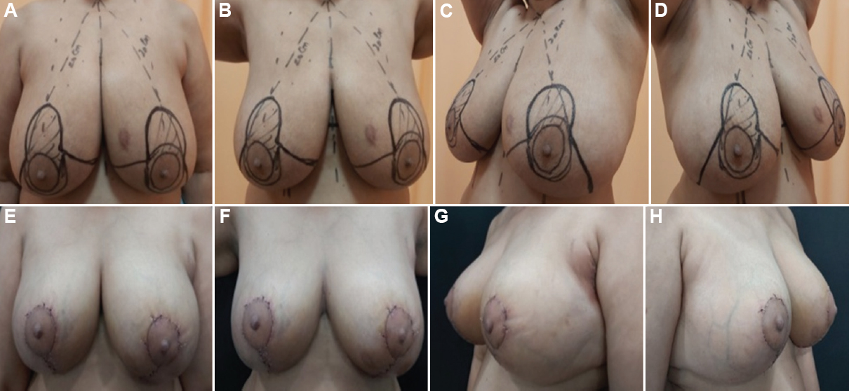 Bilateral wise-pattern reduction mammoplasty in ptotic breast with superomedial pedicle (left breast lower central primary tumor); (A-D) preoperative; and (E-H) postoperative.