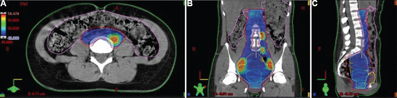 Volumetric modulated arc therapy treatment plan for a FIGO stage IIIC1 cervical carcinoma patients with involved lymph node simultaneous integrated boost (prescription dose 45 Gy, nodal SIB 57.5 Gy, 25 fractions). (A) Axial computed tomography view of the para-aortic region with involved nodal boost. Isodose colour wash as shown in dose level legend. (B) Coronal computed tomography view of extended field radiation therapy. (C) Sagittal computed tomography view of extended field radiation therapy.