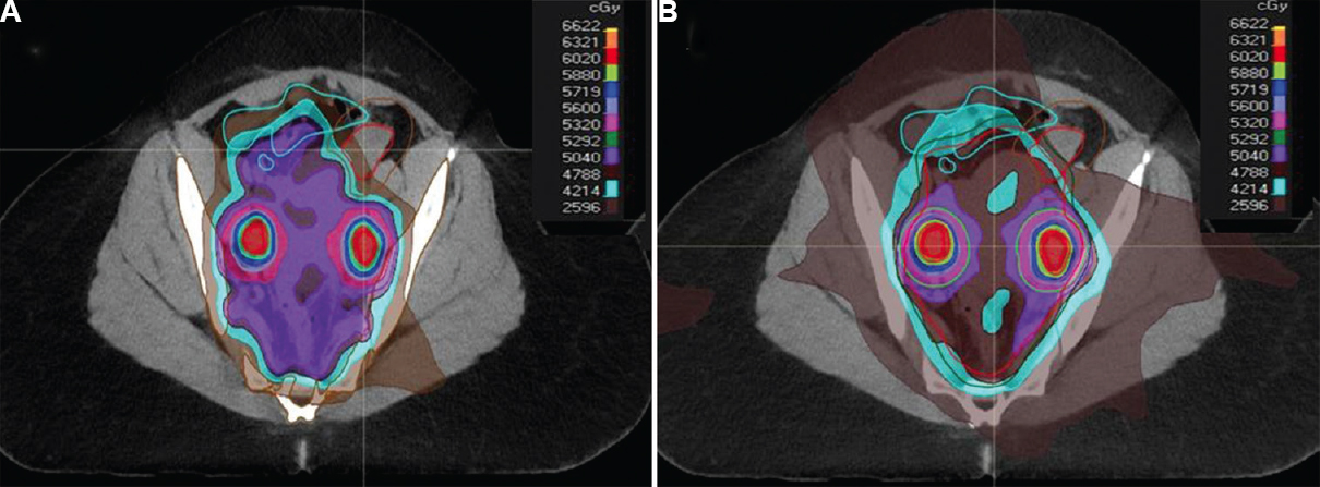 Ovarian sparing radiotherapy (prescription dose 50.4 Gy, nodal boost 60.2 Gy, 28 fraction simultaneous integrated boost). (A) Intensity-modulated proton therapy plan with pencil beam scanning technique, mean ovarian dose 20 Gy, small bowel V15 Gy = 120 cc and V45 Gy = 10 per cent, bone marrow V20 Gy = 64 per cent, V40 Gy = 22 per cent. Isodose colour wash as shown in dose level legend. (B) Volumetric modulated arc therapy plan, mean ovarian dose 30 Gy, small bowel V15 Gy = 196 cc and V45 Gy = 12 per cent, bone marrow V20 Gy = 78 per cent, V40 Gy = 29 per cent.