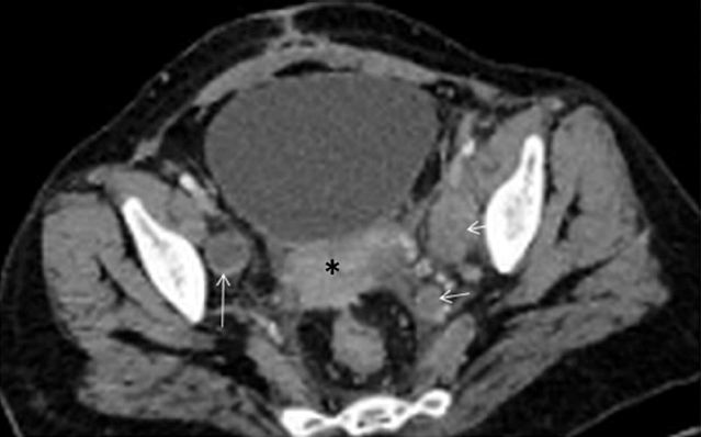 Recurrence of carcinoma cervix at the local site and iliac lymph nodes in a 37 yr old woman: axial contrast-enhanced computed tomography (CECT) section at the level of pelvis shows recurrent soft tissue mass in the region of cervix (asterisk) along with enlarged external as well as internal iliac lymph nodes (arrows).