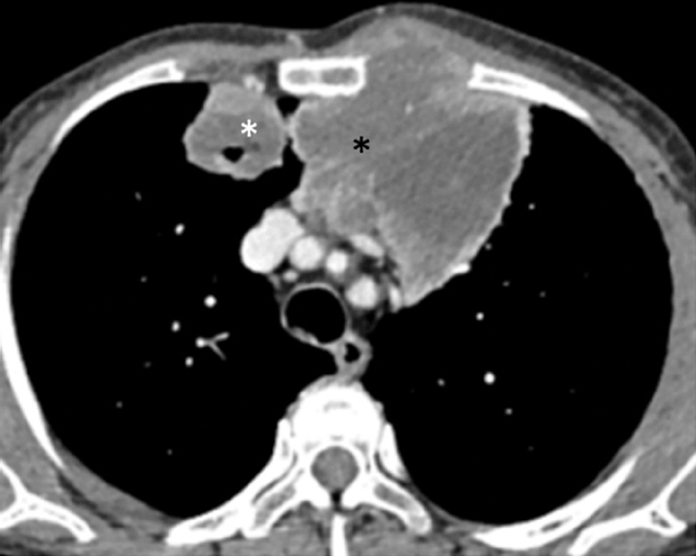 Mediastinal lymph node involvement in follow up computed tomography (CT)scan of a 59 yr old woman who was treated for carcinoma cervix: axial CECT image shows conglomerate lymph nodal mass in the pre-vascular location (black asterisk) encasing internal mammary vessels (bright dot within), infiltrating the chest wall with extra-thoracic extension in parasternal location. Also note right lung metastasis (white asterisk).