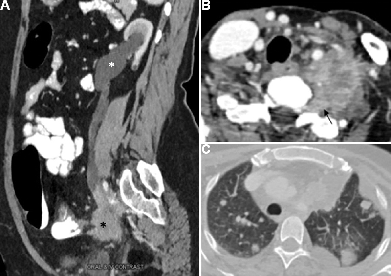 Infiltrative nature of the metastatic lymph nodes in a 50 yr old women with proven carcinoma cervix: (A) sagittal reformatted image showing presence of a spiculated irregular nodal mass in left iliac location (asterisk) infiltrating and occluding the lower ureter with upstream hydroureteronephrosis. (B) Enlarged heterogeneously enhancing soft tissue mass in left supraclavicular and paraspinal location encasing the vertebral artery and having intraspinal extension along the neural foramina (arrow) mimicking nerve sheath tumour on imaging, if seen in isolation. (C) Same patient also had multiple lung metastases.