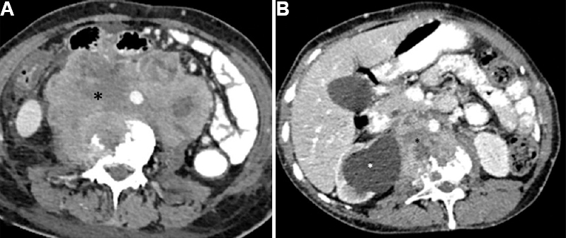 Infiltrative retroperitoneal nodes in follow up CT scan of a 42 yr old women with history of carcinoma cervix. (A) Axial CECT image in soft tissue window shows large conglomerate nodal mass in retroperitoneum with necrosis within (black asterisk). The mass is infiltrating aorta, inferior vena cava, psoas muscle and is causing erosion of the adjacent vertebral body. Anteriorly, it is infiltrating the colon also. (B) Metastatic retroperitoneal lymph nodes in a 54 yr old woman with carcinoma cervix, post treatment: Follow up CECT scan shows metastatic retroperitoneal lymph nodes (black asterisk) infiltrating aorta, vertebral body, right psoas muscle and the ureter causing upstream hydronephrosis (white asterisk). Inferior vena cava cannot be appreciated suggesting infiltration and occlusion with appearance of dilated tortuous collateral channels in the subcutaneous plane of abdominal wall.
