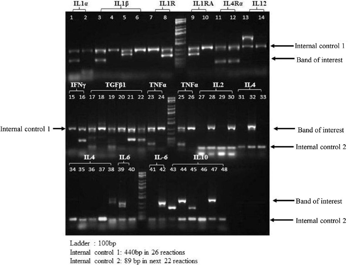 Interleukin-6-174 G/C single-nucleotide polymorphism (SNP) using commercial cytokine genotyping kit: Genotyping was done for an array of 22 SNPs using the commercially available kit. Two interleukin-6 single-nucleotide polymorphisms were part of the panel.