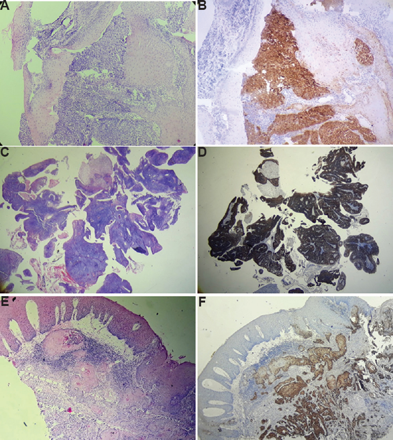 (A) Haematoxylin eosin (H&E) photomicrograph of non-keratinizing OPSCC (10x) and, (B) corresponding p16 positivity by IHC (x10); (C) H&E photomicrograph of keratinizing papillary OPSCC (x4) and, (D) corresponding p16 positivity by IHC (x4) (E) H&E photomicrograph of keratinizing OPSCC (x10) and (F) corresponding p16 positivity by IHC (x10). OPSCC, oropharyngeal squamous cell carcinoma.
