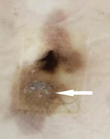 An ill-defined, firm, indurated plaque in and around the umbilicus (arrow) was found on examination.