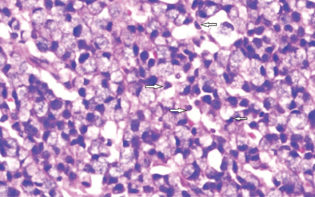Hematoxylin & eosin staining of skin biopsy sample showing extensive infiltration of the dermis by poorly differentiated adenocarcinoma cells (arrows, ×400).