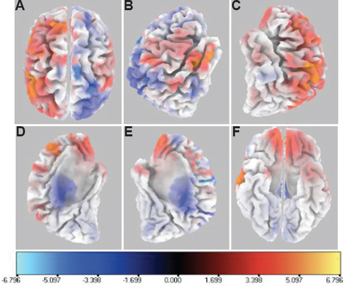 Six orthogonal views for 500 msec epoch segment showing mean difference in current source density for gyri with significantly different cortical activity during Sternberg Working Memory Task as compared to baseline. (A) top view; (B) right view; (C) left view; (D) left hemisphere right view; (E) right hemisphere left view; and (F) bottom view. The scale provided measures the t statistics based on SnPM analysis comparing the current source density in (nA/mm2) of task versus baseline conditions. Blue-coloured areas indicate lower activity, while red–yellow colour highlights higher cortical activity.