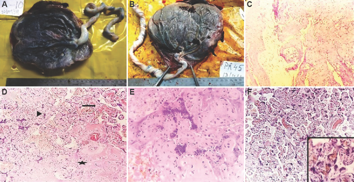 (A) Placenta with eccentric insertion of the umbilical cord. (B) Placenta with velamentous insertion of the umbilical cord. (C) Section from the placental membrane showing atheroma formation in a vessel (H and E, ×100). Inset showing high-power view of the same (H and E, × 400). (D) Microscopic appearance of infarct showing degenerative changes in villi (star). There was gradient of ischaemic injury at the periphery with collapse of intervillous space (arrowhead). Distal villous hypoplasia is noted in adjacent parenchyma (arrow). (E) Microscopic appearance of infarct showing collapse of intervillous space, villous agglutination, smudging of nuclei, pyknosis and karyorrhexis (H and E, ×400). (F) Section showing increased syncytial knots in terminal villi (H and E, ×100). Inset showing high-power view of the same.