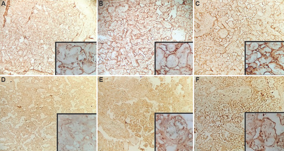 (A-C) Annexin A5 expression in the placenta of pre-eclampsia: Expression intensity (A) 1; (B) 2; (C) 3 (H and E, ×100). (D-F) Apelin expression in the placenta of pre-eclampsia: Expression intensity (D) 1; (E) 2; (F) 3 (H and E, ×100). The insets show high-power view of the respective images.