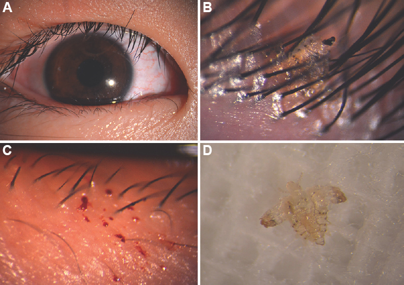 Slit-lamp examination of phthiriasis palpebrarum. (A) Mild conjunctival congestion. (B) Louse were partially buried into the eyelid skin. (C) Multiple red pinpoint lesions. (D) Louse body after it was mechanically removed.