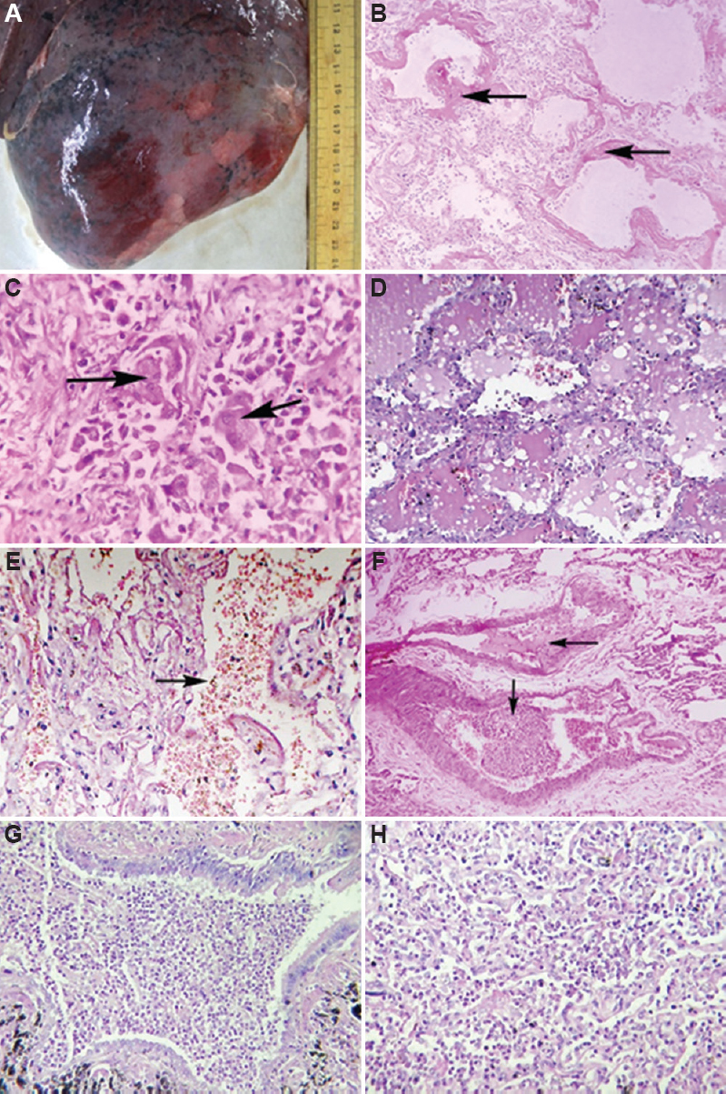 Macroscopic and microscopic findings of the lungs. (A) An oedematous and haemorrhagic outer surface with patchy areas. (B) Exudative Diffuse Alveolar Damage – Hyaline membrane (black arrows) and mononuclear inflammatory cells in alveolar septa. (C) Proliferative Diffuse Alveolar Damage – Type 2 pneumocytes hyperplasia (black arrow). (D) Intraalveolar oedema.(E) Intraalveolar haemorrhage (black arrow).(F) Thrombi within segmental branches of the pulmonary artery (black arrows) (G) Bronchopneumonia showing abundant acute inflammatory cells. (H) Lung abscess showing acute inflammatory cells with necrotic debris. (B-H, H and E, ×40).