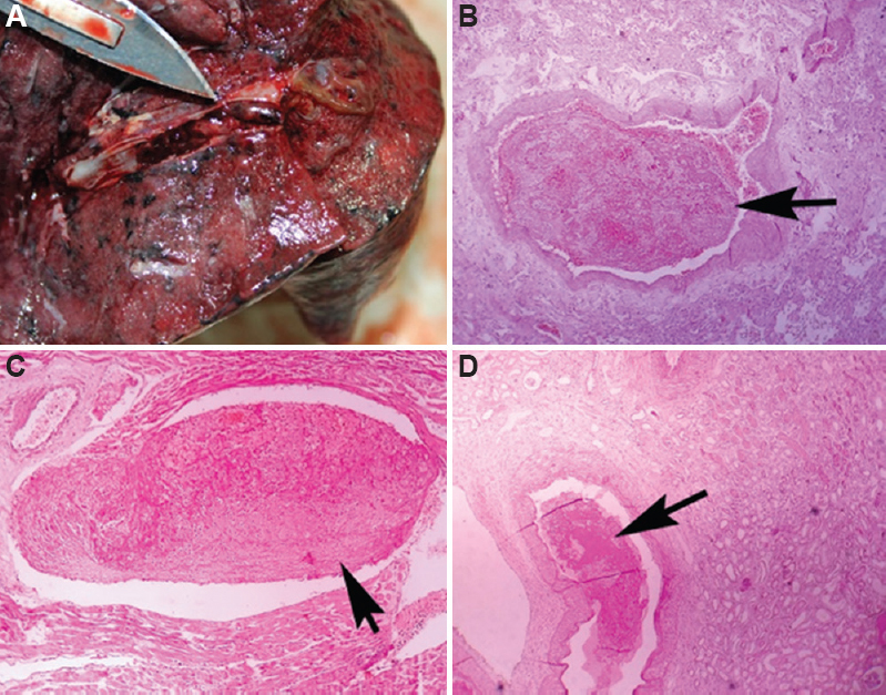 Macroscopic and microscopic thrombi in various organs. (A) Thrombus adherent to vascular wall in a cut section of lung. (B) Pulmonary vascular thrombus (H and E, ×40). (C) Intramyocardial thrombus (H and E, ×40). (D) Renal vascular thrombus, (H and E, ×10).
