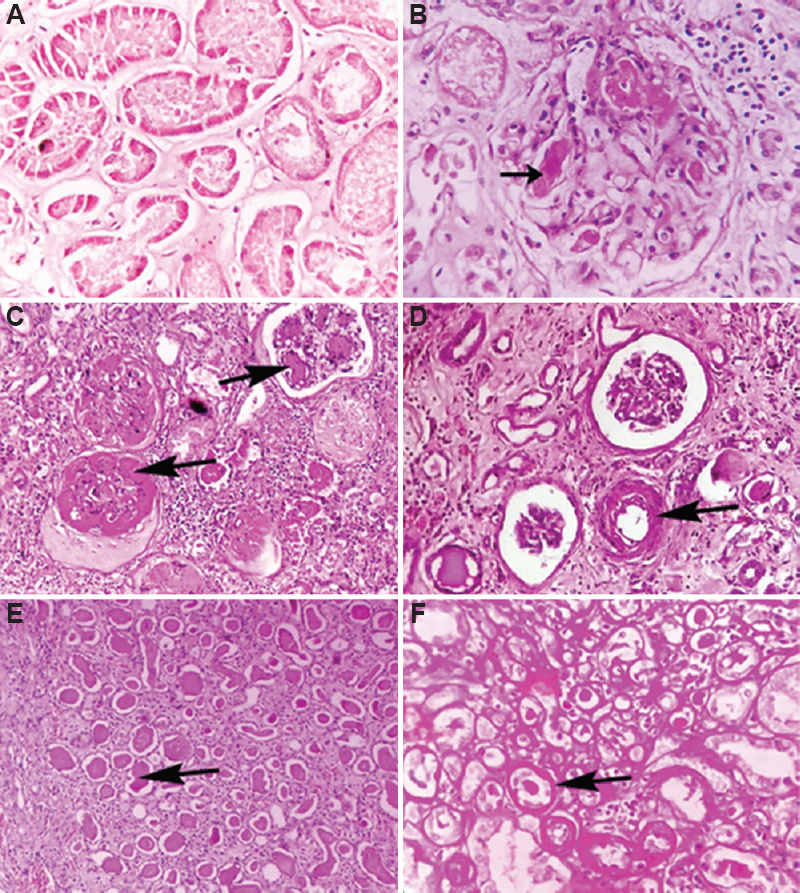 Microscopic findings of the kidneys. (A) Acute tubular injury – Flattened and necrosed tubular epithelium with intratubular cast (H and E, ×40). (B) Fibrin thrombi within glomerular capillaries (black arrow) (H and E, ×40). (C) Nodular glomerulosclerosis (black arrows) (PAS, ×40). (D) Hyaline arteriolosclerosis (black arrow) (H and E, ×40). (E) Thyroidization of tubules (black arrow) (H and E, ×10). (F) Atrophic tubules with thickened basement membrane (black arrow), (PAS, ×10).