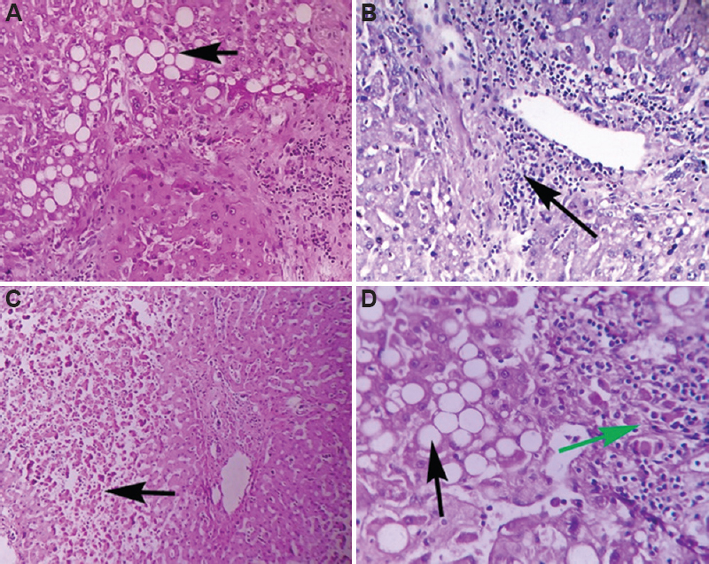 Microscopic findings of the liver. (A) Microvesicular steatosis (black arrow) (H and E, ×10). (B) Periportal inflammatory infiltrates (black arrow) (H and E, ×40). (C) Focal necrosis of hepatocytes (black arrow) (H and E, ×10). (D) Steatohepatitis - Fatty vacuoles (black arrow) with inflammatory cells (green arrow), (H and E, ×40).