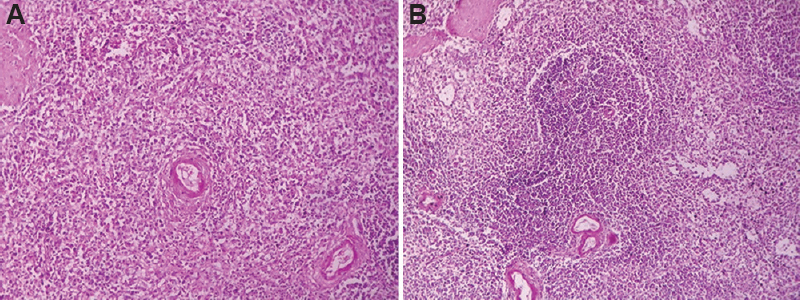 Microscopic findings of the spleen. (A) Lymphoid hypoplasia in white pulp (H and E, ×10).(B) Normal white pulp (H and E, ×10).