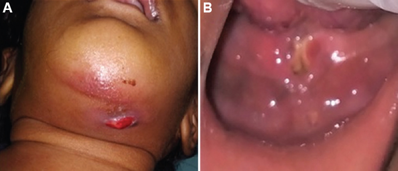 (A) Image showing draining sinus in the left side of the mandible. (B) Image showing exposed alveolar bone in the mandible with denuded mucosa.
