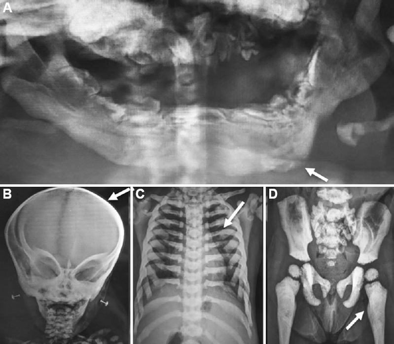 (A) Panoramic radiograph showing maxilla and mandible alveolar bone with multiple unerupted malformed tooth buds and mixed radiolucency and radiopacity with resorption of the lower border of the left side of the mandible (arrow). (B) Image showing increased thickening of the calvarium (arrow). (C) Image showing bone within the bone appearance of ribs. (D) Image showing the increased density of bones with reduced bone marrow (arrow).
