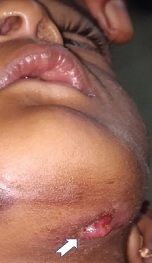 Image showing the healing sinus in the left side of the mandible.