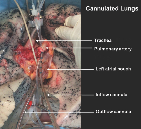 Donor lung at the start of ex vivo lung perfusion with the endotracheal tube and cannula in place.