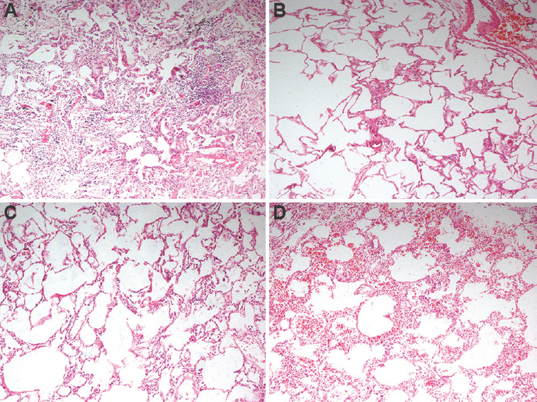 Representative histopathology images from two lung pairs which underwent EVLP; (A) Lung pair A2 at lung recovery from the donor; (B): Lung pair A2 after four hours of EVLP demonstrating scant infiltration of lymphocytes; (C) Lung pair C1 at recovery demonstrating expanded alveoli and scant intra-alveolar macrophages; (D) Lung pair C1 after four hours of EVLP demonstrating mild intra-alveolar and septal haemorrhage. No evidence of ischaemia or thrombosis noted in any of the images. EVLP, ex vivo lung perfusion; A2, lung pair in the acellular group, C1, lung pair in the cellular group.