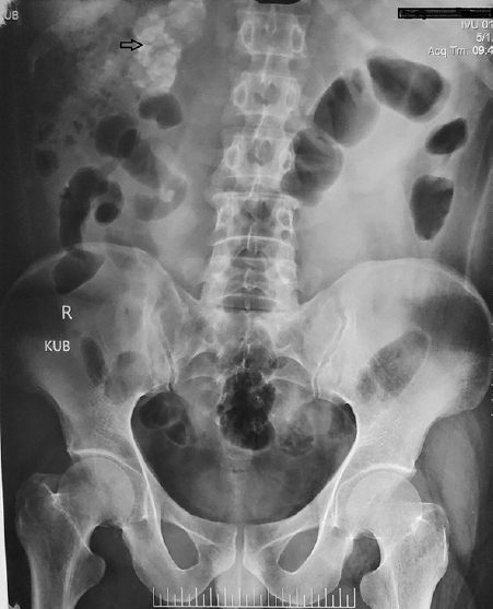 Plain radiograph showing dense reniform opacity (arrow) in the right renal area.