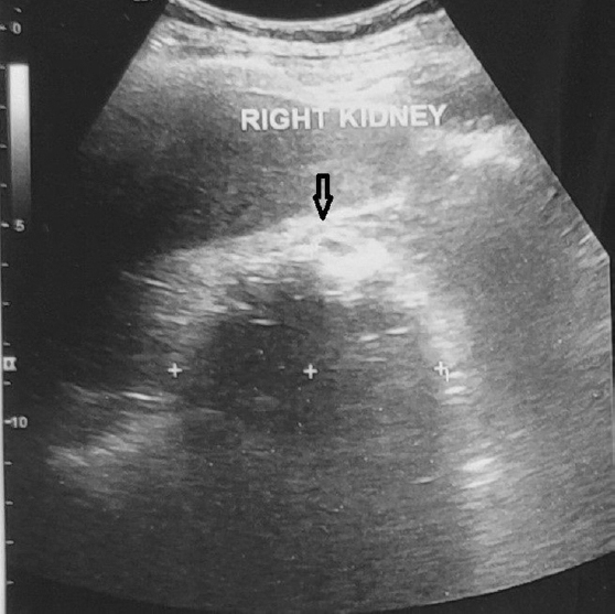 Contracted and echogenic right kidney (arrow) detected on ultrasound.