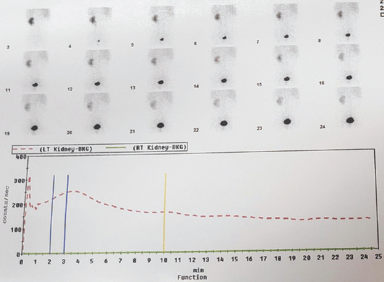 Renal scintigram (99m Tc-DTPA) showing non-functioning right kidney.