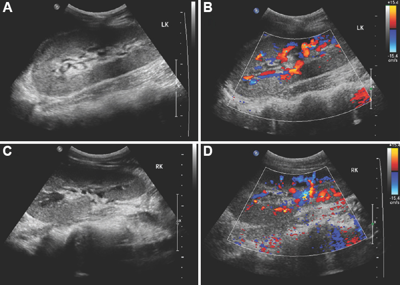 Renal ultrasound before treatment indicated that there were no obvious abnormalities in the size, shape and sonographic manifestations of both kidneys. Panel A and B show the left kidney and C and D represent the right kidney.