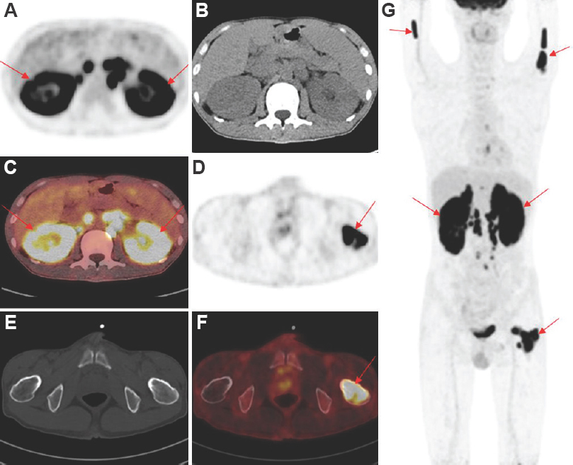 PET/CT images before chemotherapy. Panel A-C show renal PET, CT and PET/CT fusion images, respectively. Panel D-F show PET, CT and fused PET/CT images of the left femoral neck, respectively. (G) MIP image shows abnormal FDG uptake in the bilateral kidneys and humerus, left femoral neck and retroperitoneal lymph nodes. The SUVmax of kidney and bone lesions were 18.1 and 17.0, respectively. Arrows indicate lesions. FDG PET/CT, flurodeoxyglucose positron-emission computed tomography, MIP, maximum intensity projection; SUVmax, maximum standardized uptake value.