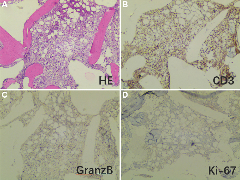 The left femur neck lesion biopsy under the guidance of PET/CT. (A) Haematoxylin and eosin staining showing normal bone marrow structural destruction, with small remnants of adipose tissue and proliferating fibrous connective tissue and atypical lymphocyte infiltration. Immunohistochemical results: (B) MPO (−), CD235 (erythrocyte +), CD61 (−), CD3 (+), (C) CD20 (−), GranzB (scattered +), (D) ki-67 (hot spot LI about 20%+), CD56 (−), CD30 (−), ALK(ALK1), CD138 (−), EBER-CISH (−). Combined with clinical data, it was considered that non-Hodgkin’s cytotoxic T-cell lymphoma involves bone marrow. (A-D, ×20).